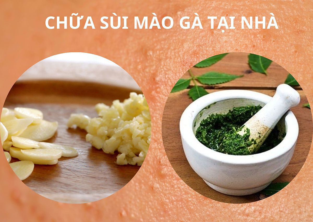 Kinh nghiệm chữa Sùi mào gà theo dân gian